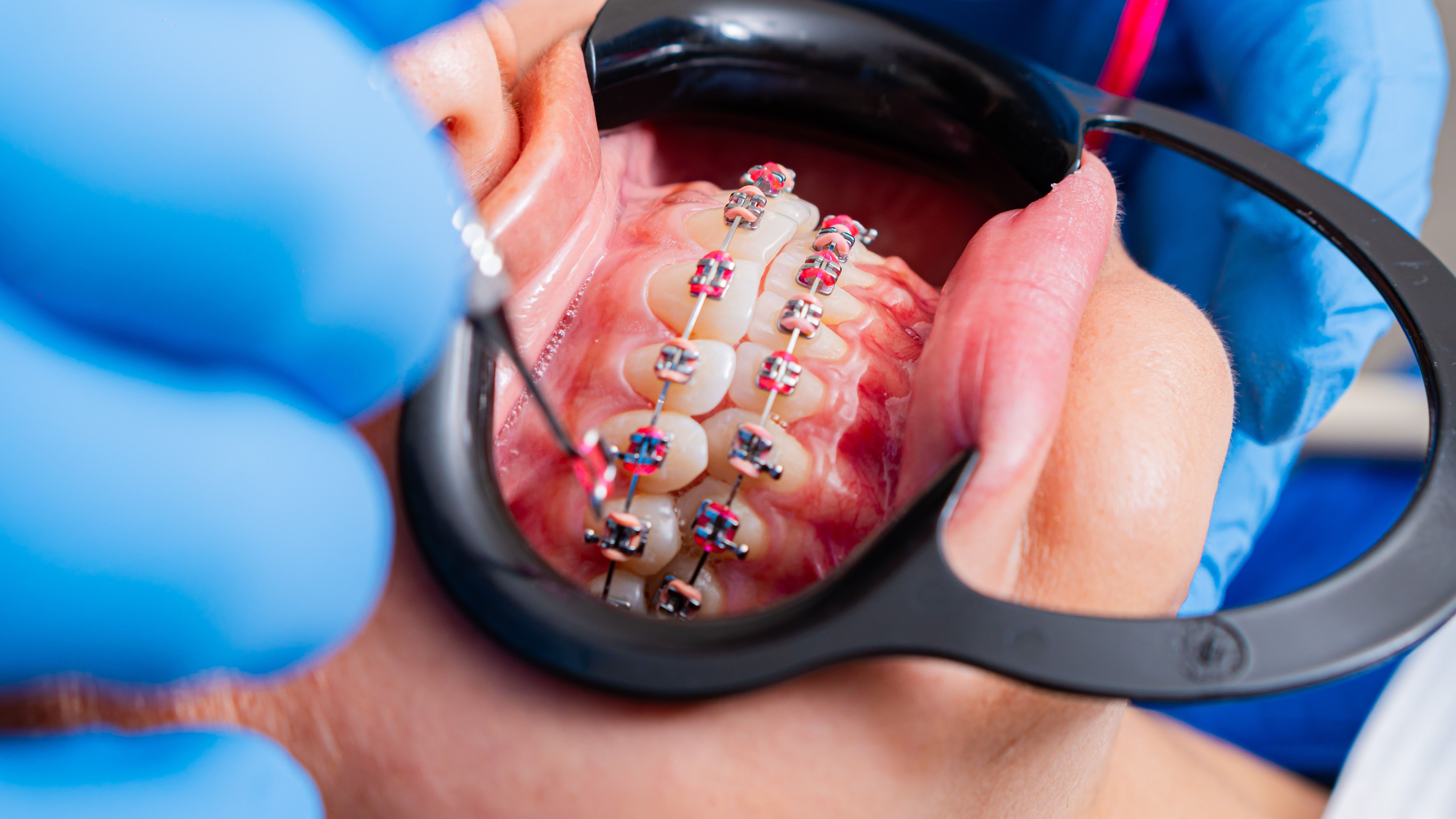 Aparaty ortodontyczne stałe i ruchome – czym się różnią i kiedy który rodzaj jest właściwym wyborem?